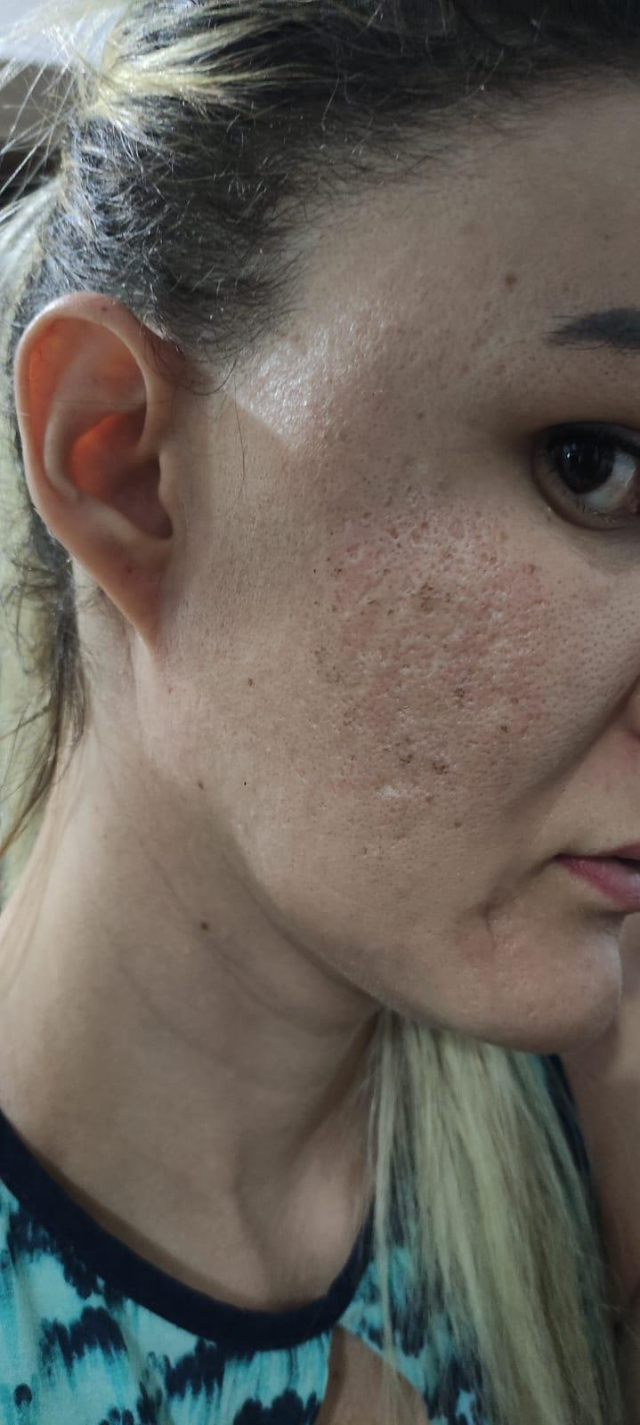 Resultado Antes - Protocolo de Acne