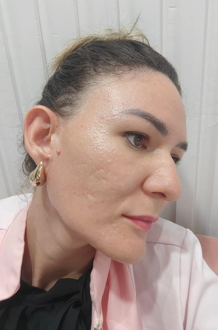 Resultado Depois - Protocolo de Acne
